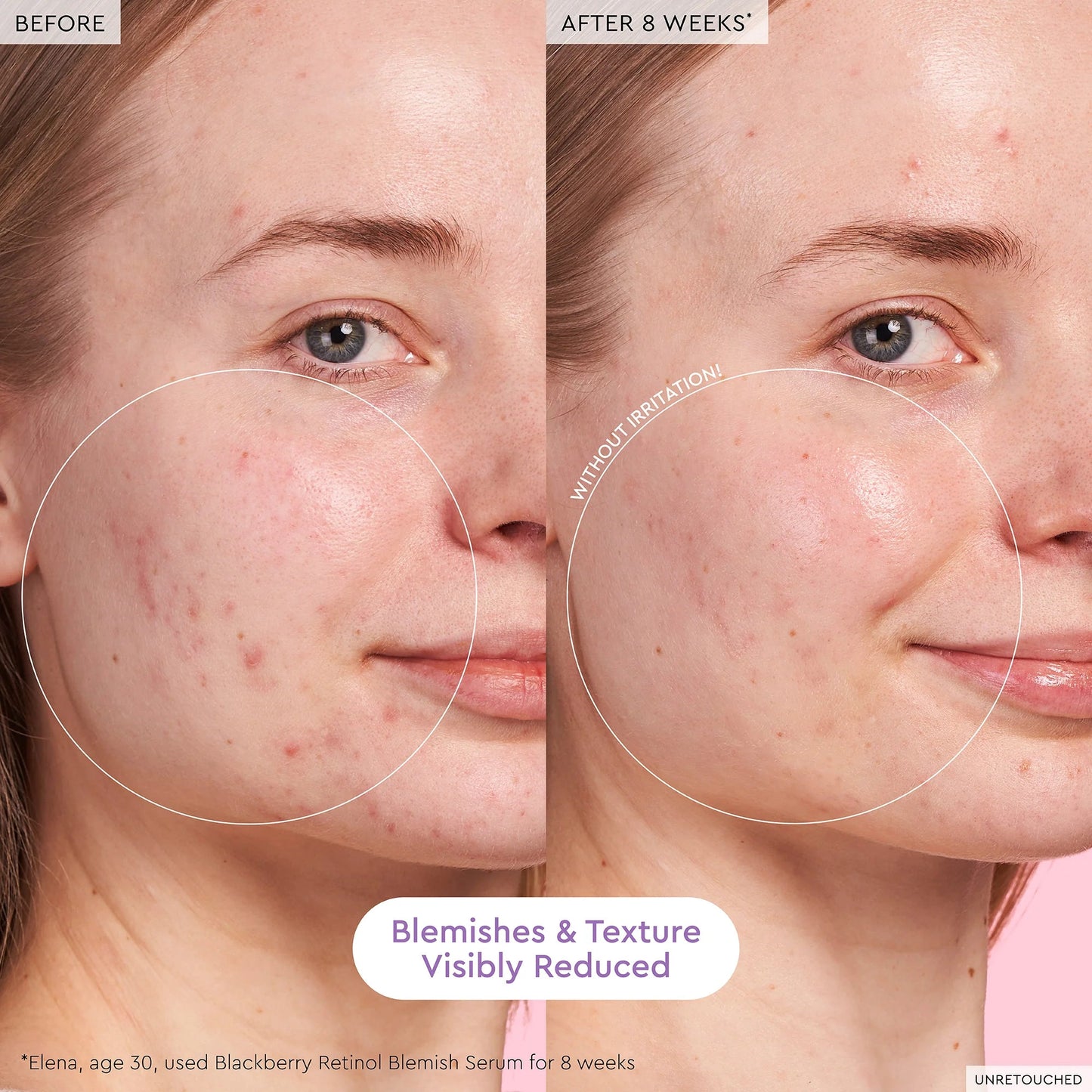 Blackberry Retinol Blemish Serum - BELLA NOVA BEAUTY (PTY) LTDRetinol Blemish SerumGlow RecipeBELLA NOVA BEAUTY (PTY) LTD