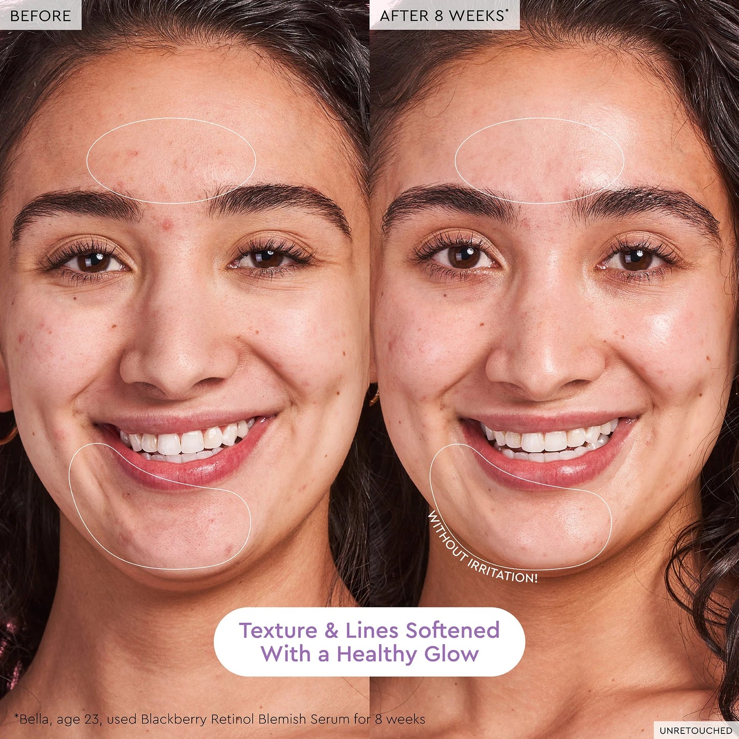 Blackberry Retinol Blemish Serum - BELLA NOVA BEAUTY (PTY) LTDRetinol Blemish SerumGlow RecipeBELLA NOVA BEAUTY (PTY) LTD