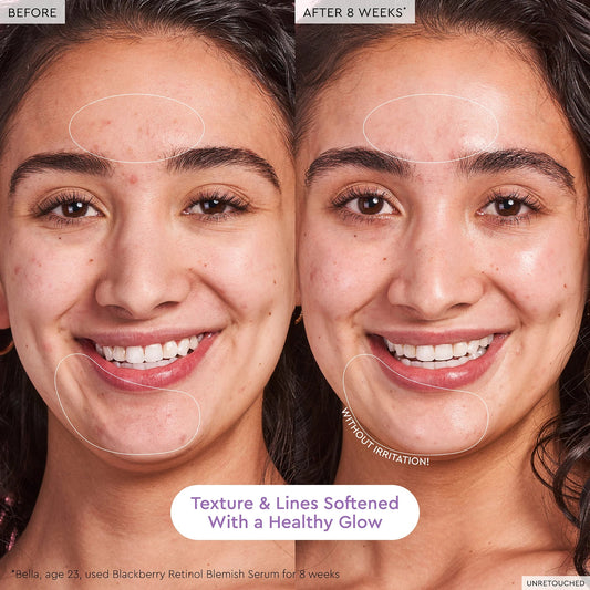 Blackberry Retinol Blemish Serum - BELLA NOVA BEAUTY (PTY) LTDRetinol Blemish SerumGlow RecipeBELLA NOVA BEAUTY (PTY) LTD