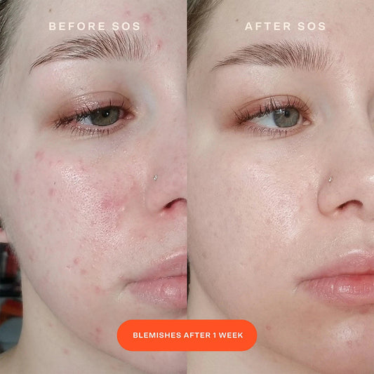SOS Intensive Redness Relief Serum with Hypochlorous Acid - BELLA NOVA BEAUTY (PTY) LTDSOS Serum - Intense Redness ReliefTower 28BELLA NOVA BEAUTY (PTY) LTD
